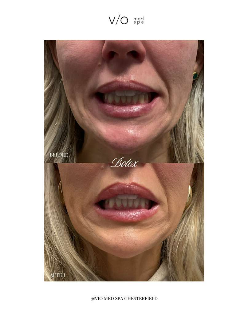 Neurotoxins before and after — Chin & DAO softening