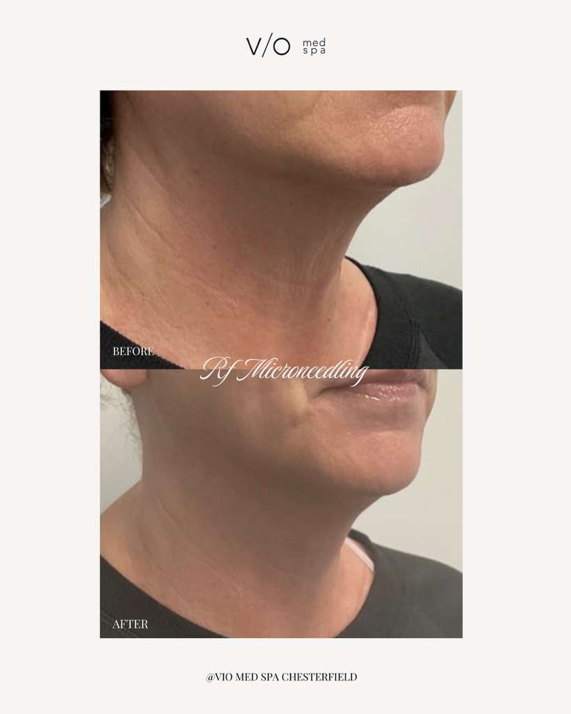 RF Microneedling before and after — RF Microneedling
