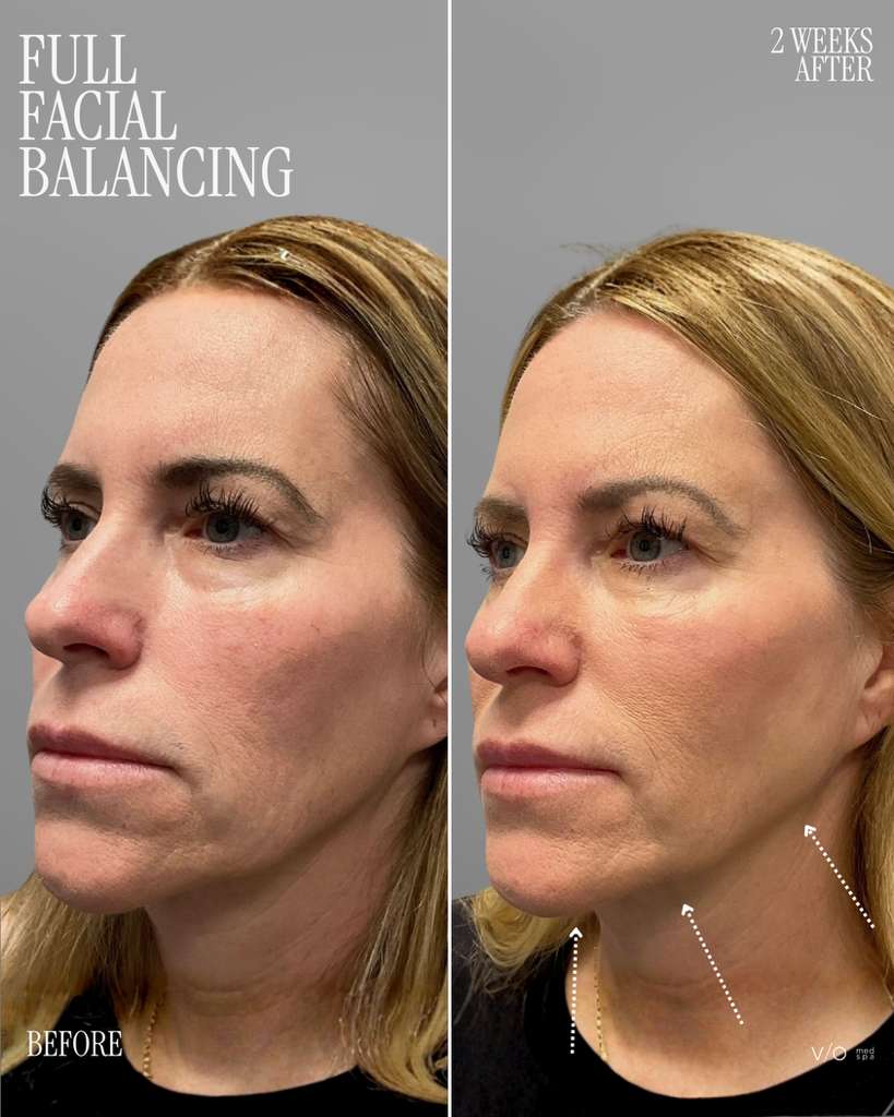 Dermal Fillers before and after — Facial balancing