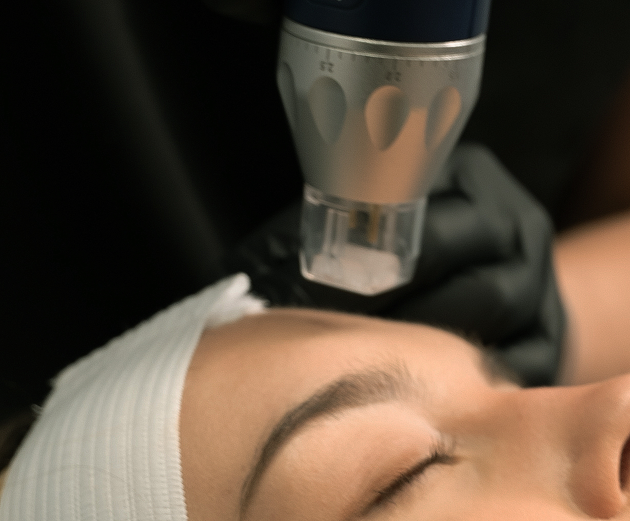Client during treatment at VIO