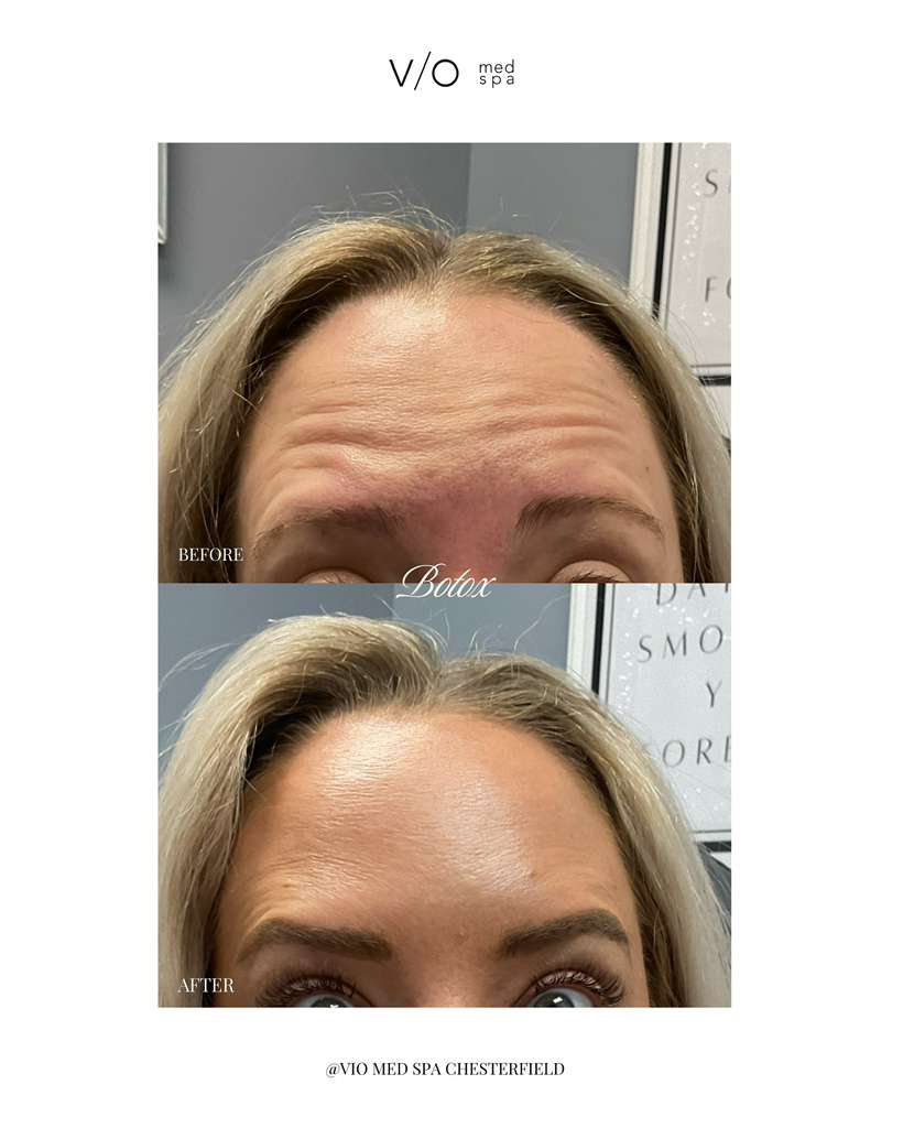 Neurotoxins before and after — Forehead smoothing