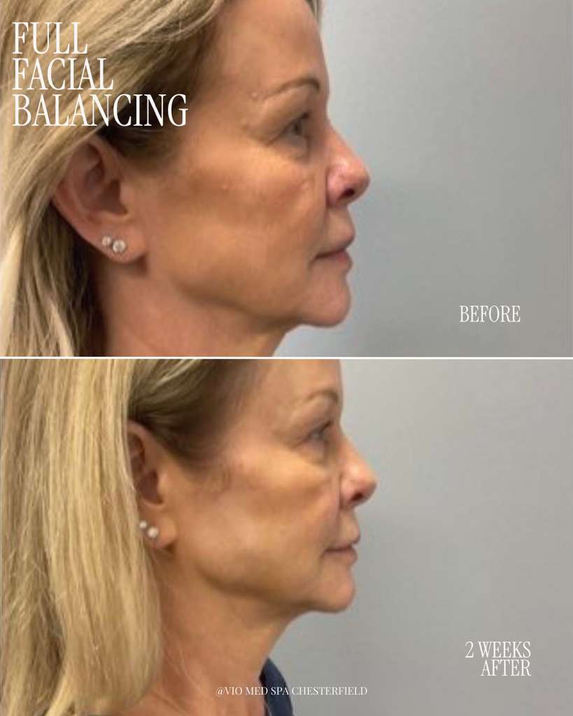Dermal Fillers before and after — Facial balancing