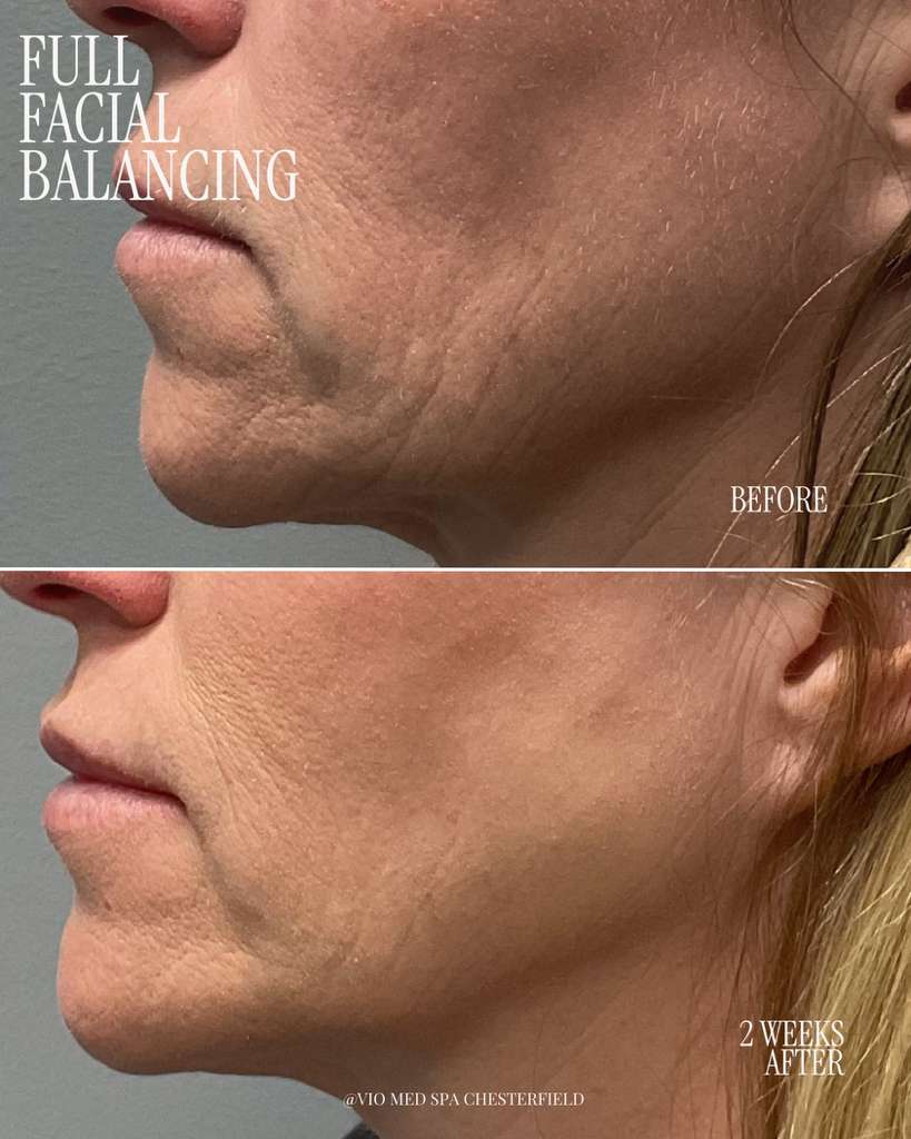 Dermal Fillers before and after — Facial balancing