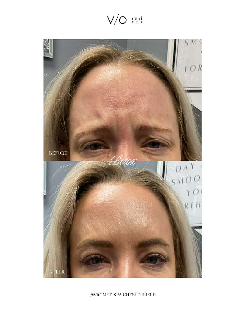 Neurotoxins before and after — 11's — Glabellar lines