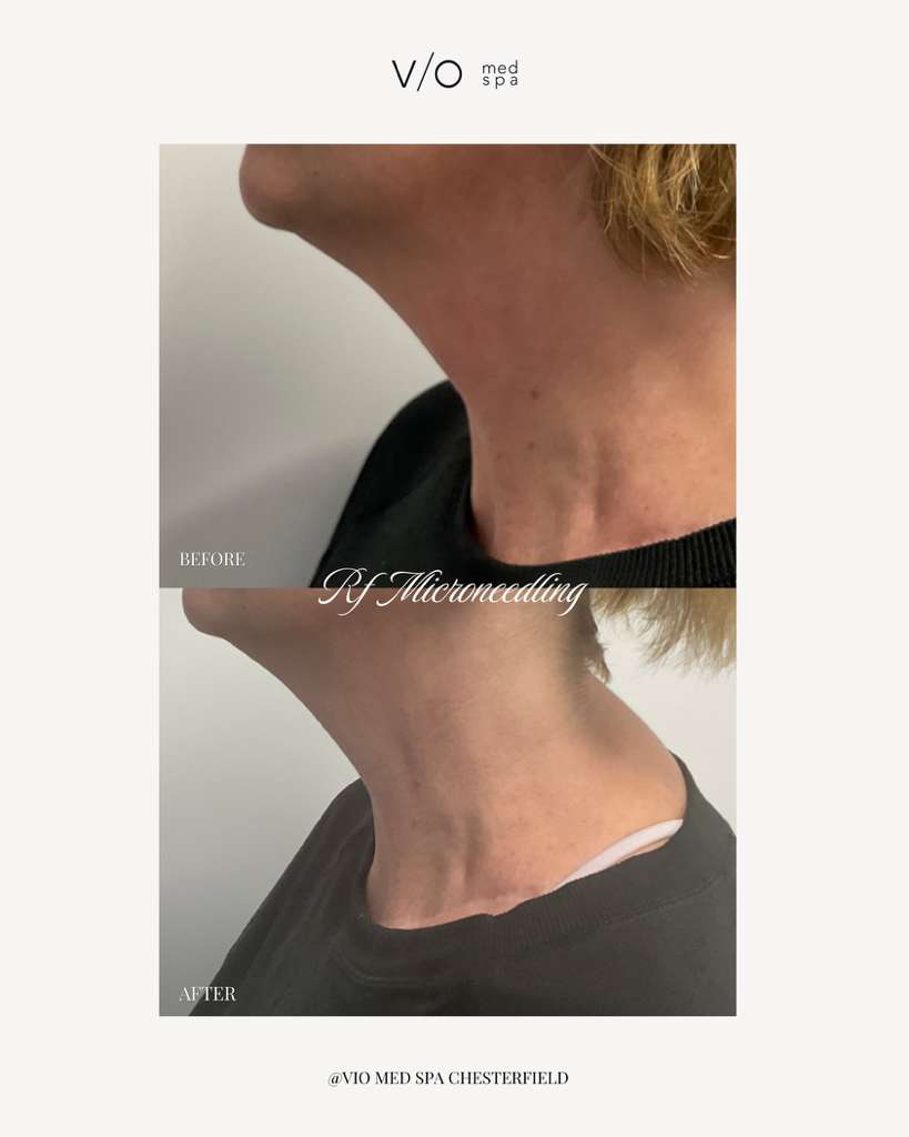 RF Microneedling before and after — RF Microneedling