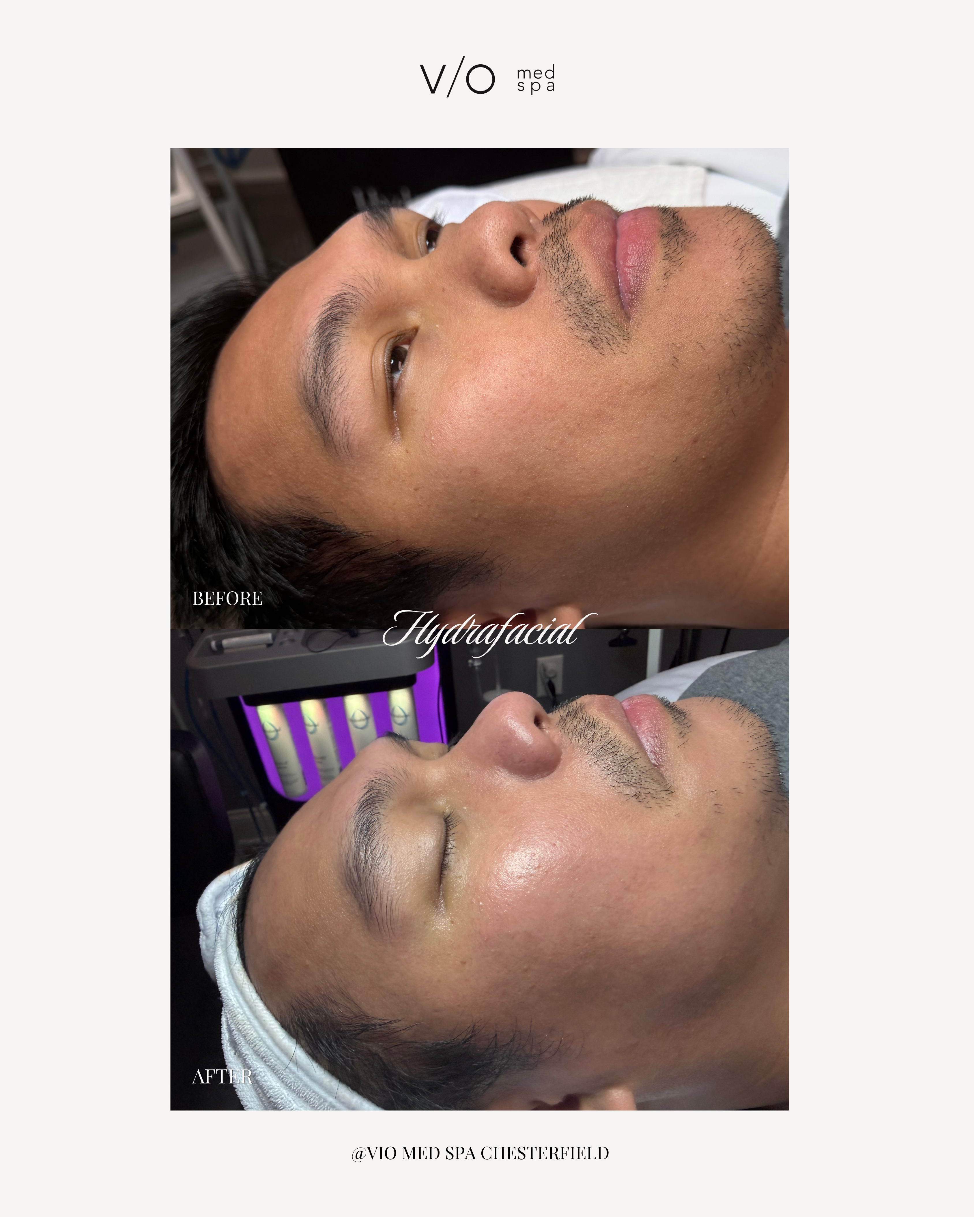 Facials before and after — HydraFacial